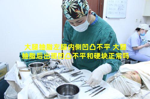 大腿抽脂左腿内侧凹凸不平 大腿抽脂后出现凹凸不平和硬块正常吗